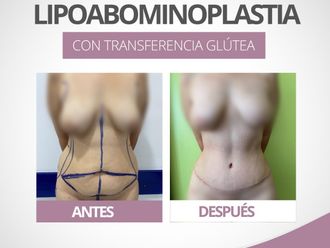 Abdominoplastía antes y después - 843350