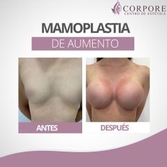 Aumento mamario - Centro de Estética Corpore