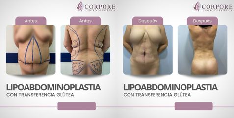 Lipoabdomindoplastia - Centro de Estética Corpore