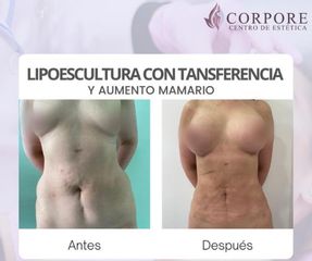 Lipoescultura - Centro de Estética Corpore