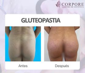 Aumento de glúteos - Centro de Estética Corpore