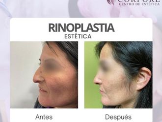 Rinoplastía antes y después - 843792