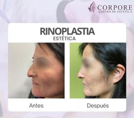 Rinoplastia - Centro de Estética Corpore