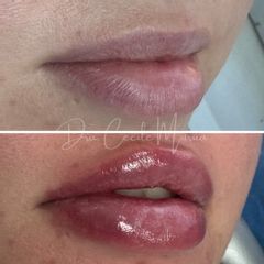 Aumento labios - Dra. Cecile Murúa Barahona