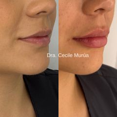 Relleno de Labios - Dra. Cecile Murúa Barahona