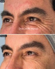 Botox -Dra. Cecile Murúa Barahona
