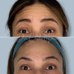 Botox - Dra. Cecile Murúa Barahona