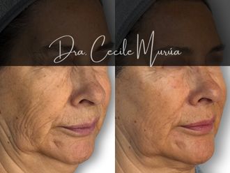 Rejuvenecimiento facial antes y después - 874248