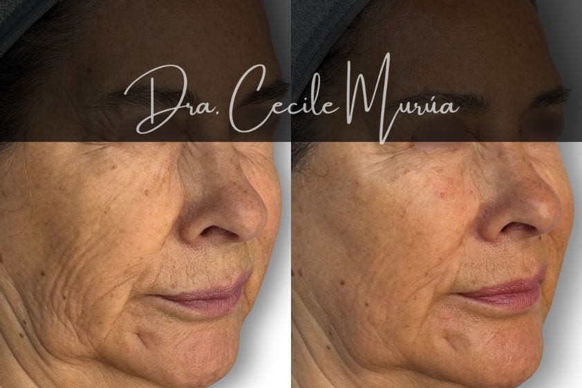 Rejuvenecimiento facial antes y después - 874248