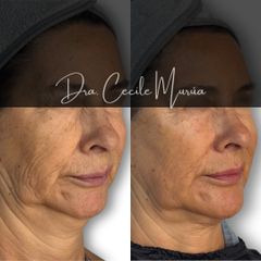 Adipoestructuración Facial - Dra. Cecile Murúa Barahona