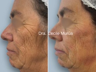 Rejuvenecimiento facial antes y después - 874249