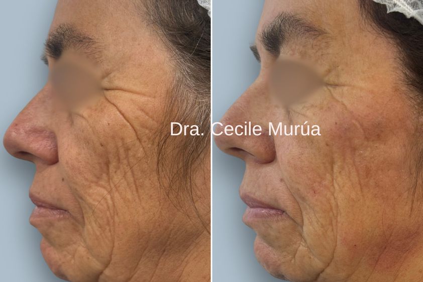 Rejuvenecimiento facial antes y después - 874249