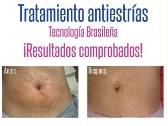 Eliminar las estrías antes y después - 490877