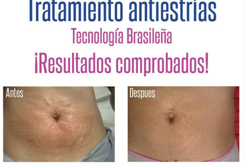 Eliminar las estrías antes y después - 490877