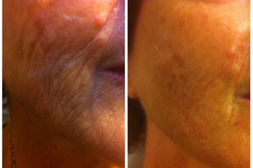 Plasma rico en plaquetas antes y después - 501495