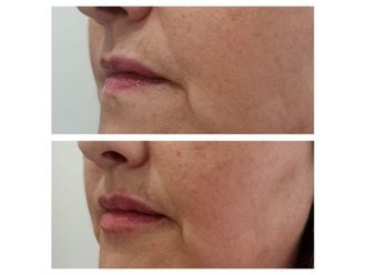 Aumento de labios - 643602