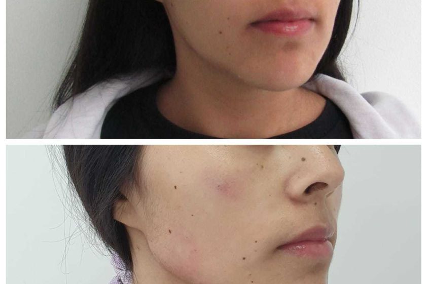 Cirugía maxilofacial antes y después - 649822