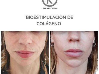 Rejuvenecimiento facial - 661252
