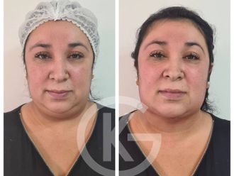 Liposucción - 661711