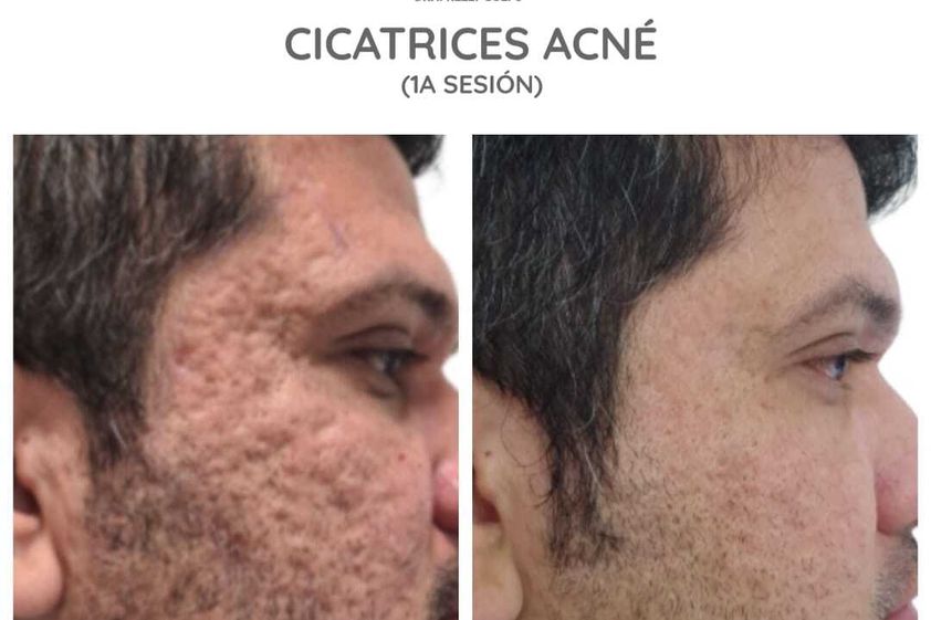 Tratamiento acné antes y después - 662908