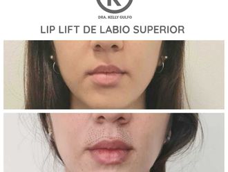 Aumento de labios-663527