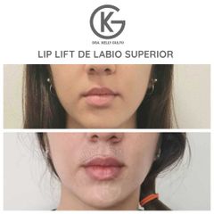 Lip Lift - Dra. Kelly Gulfo