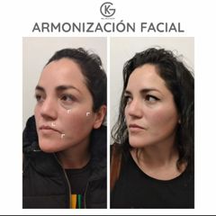 Armonización Facial