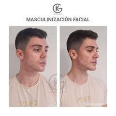 Masculinización facial - Dra. Kelly Gulfo