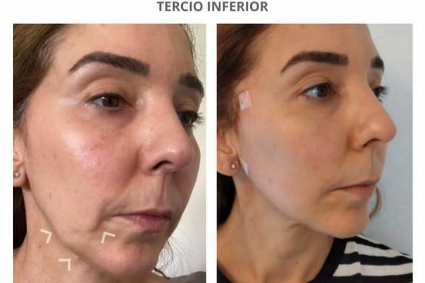 Hilos tensores antes y después - 776285