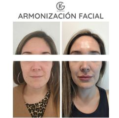 Armonización facial - Clínica Dra. Kelly Gulfo