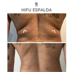 HIFU - Clínica Dra. Kelly Gulfo