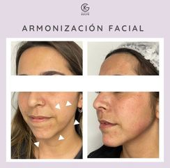 Armonización facial