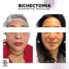 Bichectomía antes y después