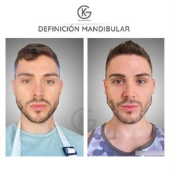Masculinización facial - Clínica Dra. Kelly Gulfo