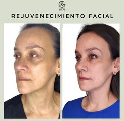 Rejuvenecimiento facial - Clínica Dra. Kelly Gulfo