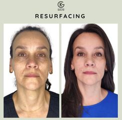 Rejuvenecimiento facial - Clínica Dra. Kelly Gulfo