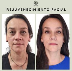 Rejuvenecimiento facial - Clínica Dra. Kelly Gulfo