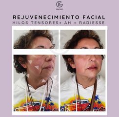Hilos tensores - Clínica Dra. Kelly Gulfo