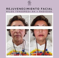 Hilos tensores - Clínica Dra. Kelly Gulfo