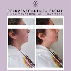 Hilos tensores - Clínica Dra. Kelly Gulfo