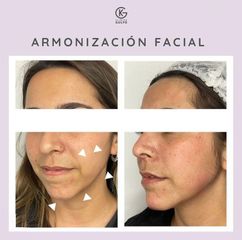 Rejuvenecimiento facial - Clínica Dra. Kelly Gulfo