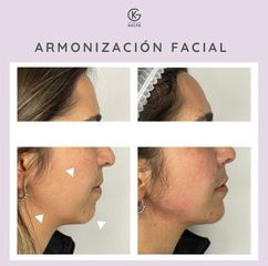 Rejuvenecimiento facial - Clínica Dra. Kelly Gulfo