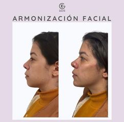Armonización facial - Clínica Dra. Kelly Gulfo