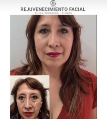 Hilos tensores - Clínica Dra. Kelly Gulfo