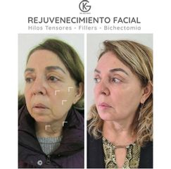 Hilos tensores - Clínica Dra. Kelly Gulfo