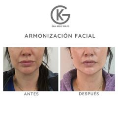 Armonización facial - Clínica Dra. Kelly Gulfo