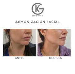 Armonización facial - Clínica Dra. Kelly Gulfo