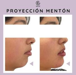 Ácido Hialurónico - Clínica Dra. Kelly Gulfo