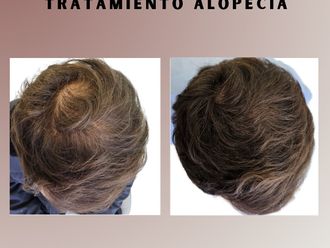 Alopecia - 865810