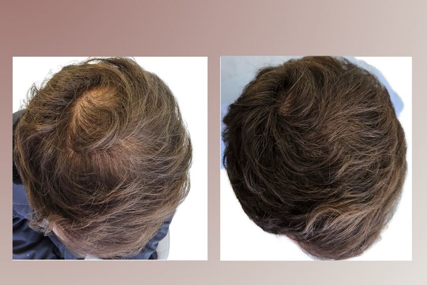 Alopecia antes y después - 865810